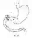 Fig. 16 - INTRAGASTRIC IMPLANT DEVICES