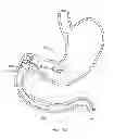 Fig. 19 - INTRAGASTRIC IMPLANT DEVICES