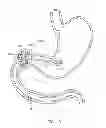 Fig. 20 - INTRAGASTRIC IMPLANT DEVICES
