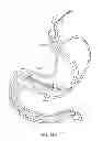 Fig. 22 - INTRAGASTRIC IMPLANT DEVICES