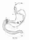Fig. 23 - INTRAGASTRIC IMPLANT DEVICES
