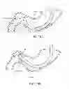 Fig. 24 - INTRAGASTRIC IMPLANT DEVICES