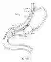 Fig. 25 - INTRAGASTRIC IMPLANT DEVICES