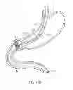 Fig. 26 - INTRAGASTRIC IMPLANT DEVICES