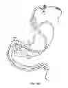 Fig. 28 - INTRAGASTRIC IMPLANT DEVICES