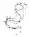 Fig. 29 - INTRAGASTRIC IMPLANT DEVICES