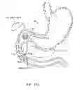 Fig. 30 - INTRAGASTRIC IMPLANT DEVICES