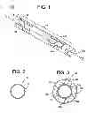 Fig. 02 - Gastric bypass devices and procedures