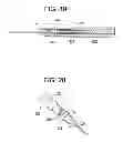 Fig. 10 - Gastric bypass devices and procedures