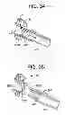 Fig. 16 - Gastric bypass devices and procedures