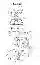 Fig. 22 - Gastric bypass devices and procedures