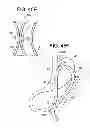 Fig. 23 - Gastric bypass devices and procedures