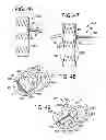 Fig. 25 - Gastric bypass devices and procedures