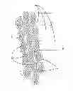 Fig. 04 - SURFACTANT PORTED DEVICE FOR TREATMENT OF BLEPHARITIS AND APPLICATIONS OF SAME