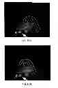 Fig. 08 - SURFACTANT PORTED DEVICE FOR TREATMENT OF BLEPHARITIS AND APPLICATIONS OF SAME