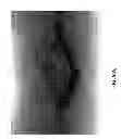 Fig. 11 - SURFACTANT PORTED DEVICE FOR TREATMENT OF BLEPHARITIS AND APPLICATIONS OF SAME