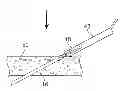 Fig. 01 - NEEDLE FOR DELIVERY OF DERMAL FILLER THREADS