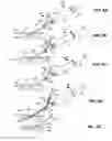 Fig. 06 - DEVICES AND METHODS FOR IMPROVED VASCULAR ACCESS