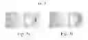 Fig. 04 - Method for treating glaucoma