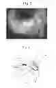Fig. 06 - Method for treating glaucoma
