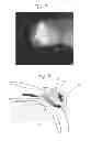 Fig. 07 - Method for treating glaucoma