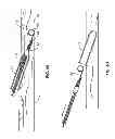 Fig. 05 - Systems and methods for needle and catheter advancement