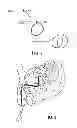 Fig. 04 - Implantable device with intravesical tolerability and methods of treatment