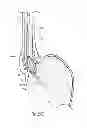 Fig. 44 - Devices, systems and methods for treating tissue regions of the body