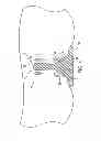 Fig. 05 - Method, apparatus and system for preventing or reducing the severity of hemorrhoids