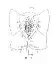 Fig. 13 - Method, apparatus and system for preventing or reducing the severity of hemorrhoids