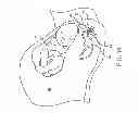 Fig. 14 - Method, apparatus and system for preventing or reducing the severity of hemorrhoids