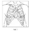 Fig. 02 - Direct aortic access system for transcatheter aortic valve procedures