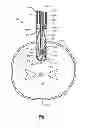 Fig. 02 - Suturing device with split arm and method of suturing tissue