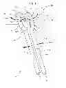 Fig. 02 - Transcend surgical clips for laproscopic procedures