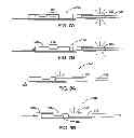 Fig. 07 - Atherectomy catheter with aligned imager