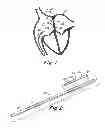 Fig. 02 - Catch members for occluder devices