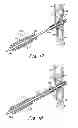 Fig. 09 - Catch members for occluder devices