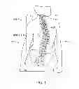 Fig. 02 - Maintenance feature in magnetic implant