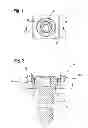 Fig. 02 - Bone fixing apparatus