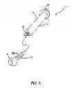 Fig. 04 - Orthopedic implant having non-circular cross section and method of use thereof