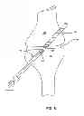 Fig. 06 - Orthopedic implant having non-circular cross section and method of use thereof