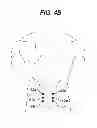 Fig. 06 - Methods and devices for minimally invasive spinal fixation element placement