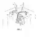 Fig. 03 - Remote pace detection in an implantable medical device