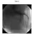 Fig. 06 - Magnesium alloy and resorbable stents containing the same