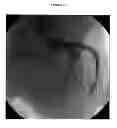 Fig. 08 - Magnesium alloy and resorbable stents containing the same