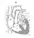 Fig. 02 - Prosthetic valve for replacing mitral valve