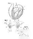 Fig. 03 - Prosthetic valve for replacing mitral valve