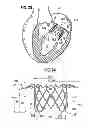 Fig. 09 - Prosthetic valve for replacing mitral valve