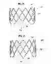 Fig. 10 - Prosthetic valve for replacing mitral valve