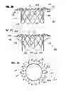 Fig. 12 - Prosthetic valve for replacing mitral valve